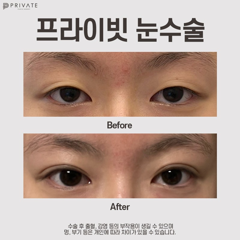 자연유착 재수술 후기 좋은 프라이빗성형외과 사진 10
