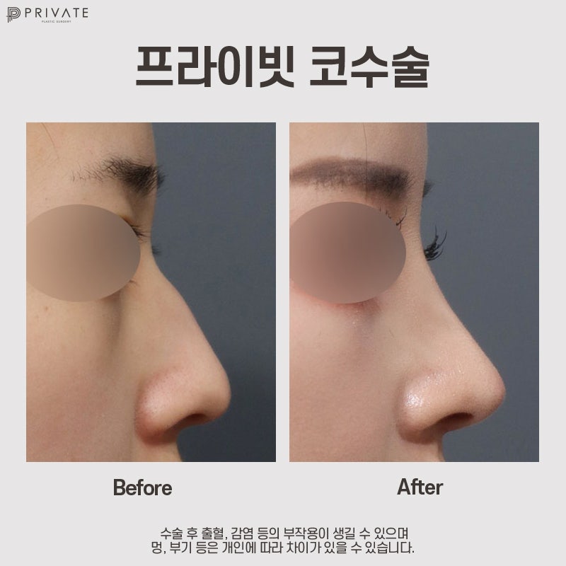 매부리코성형병원은 신사 프라이빗성형외과 사진 7