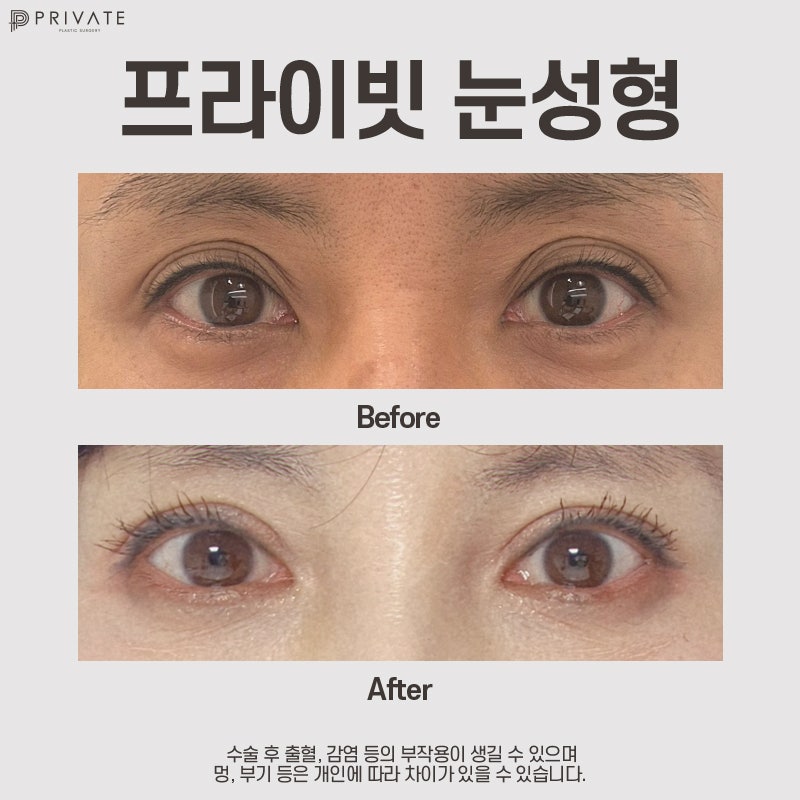 상안검수술은 신사역 프라이빗성형외과 사진 7