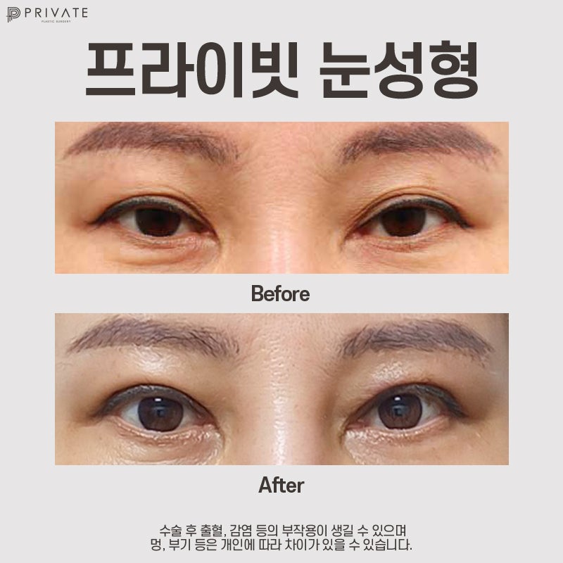 상안검수술은 신사역 프라이빗성형외과 사진 8