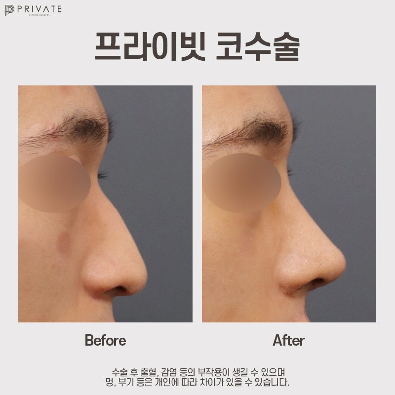 남자코성형후기가 궁금하다면, 프라이빗성형외과 사진 8