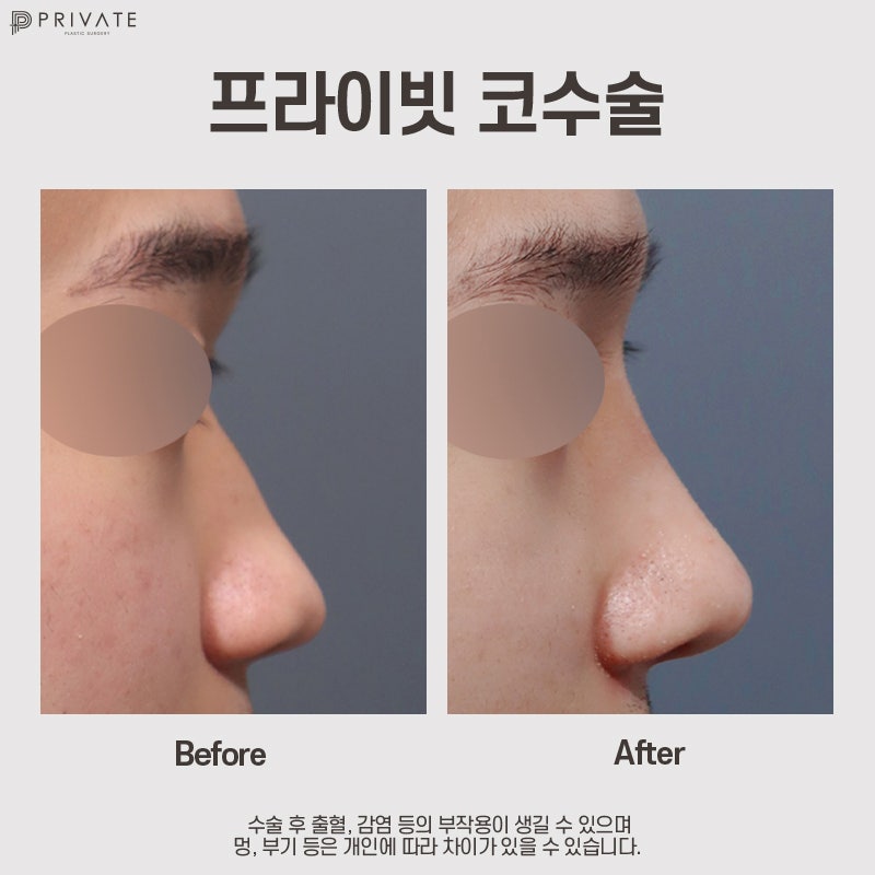 비주코성형수술은 신사 프라이빗성형외과 사진 9