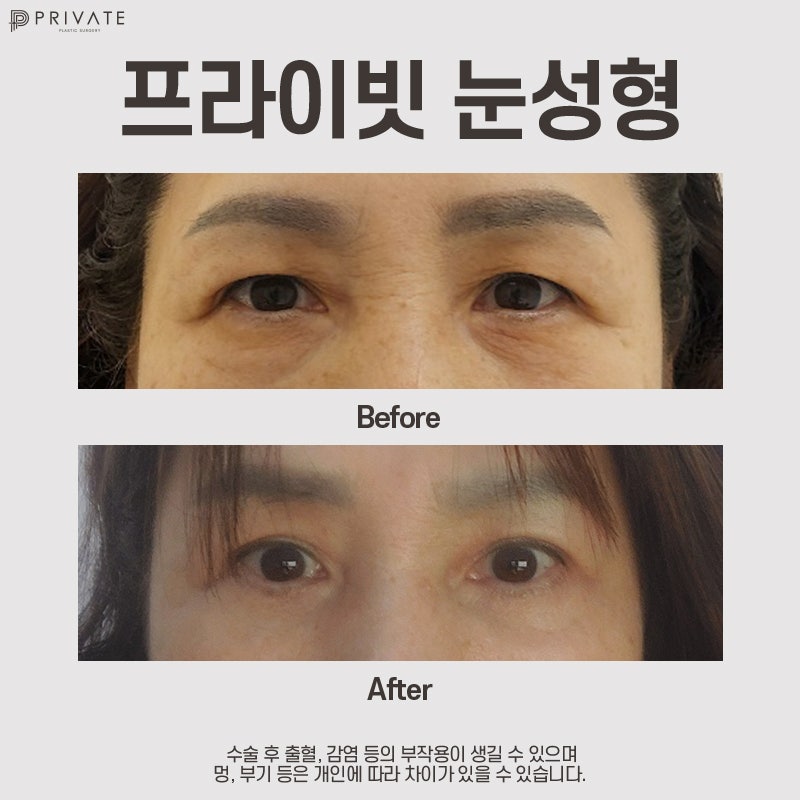 하안검수술후기 볼 수 있는 신사 프라이빗성형외과 사진 7