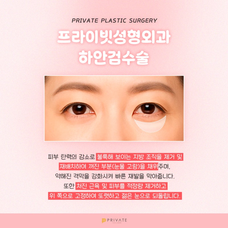 하안검수술후기 볼 수 있는 신사 프라이빗성형외과
