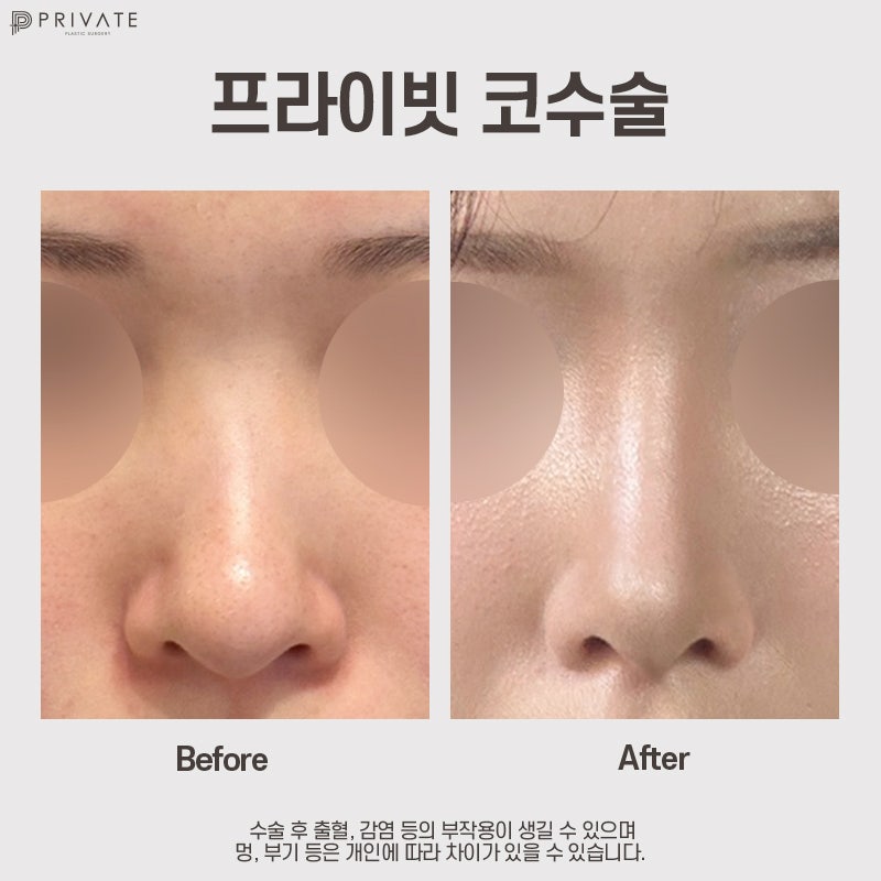 휜코 수술 후기가 좋은 신사 프라이빗성형외과 사진 7