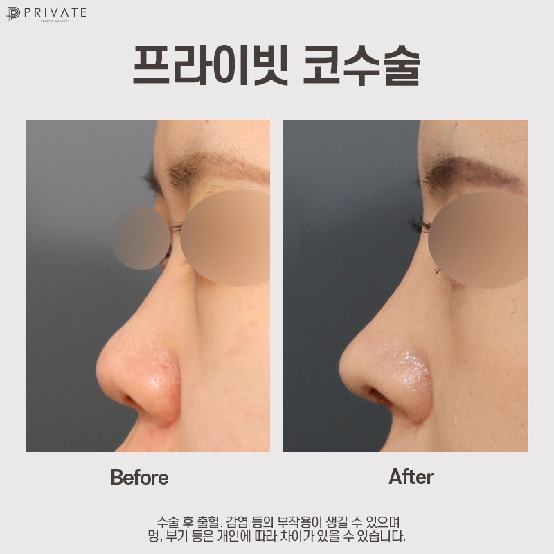 코수술잘하는병원은 신사 프라이빗성형외과 사진 8