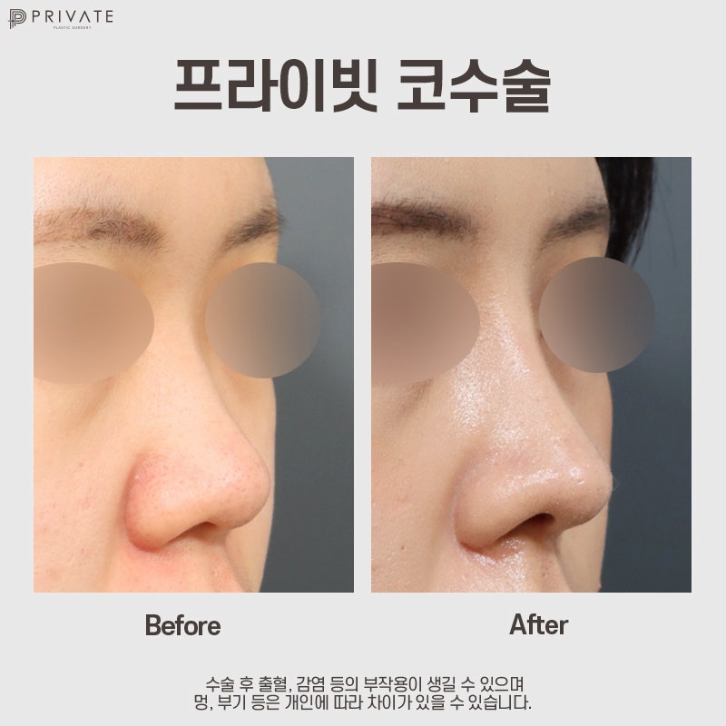 코수술잘하는병원은 신사 프라이빗성형외과 사진 9