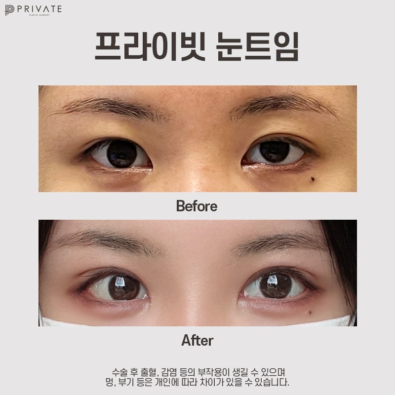 눈트임잘하는곳은 프라이빗성형외과 사진 8