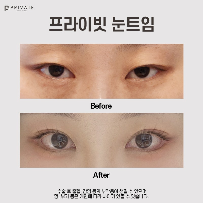 눈트임잘하는곳은 프라이빗성형외과 사진 7