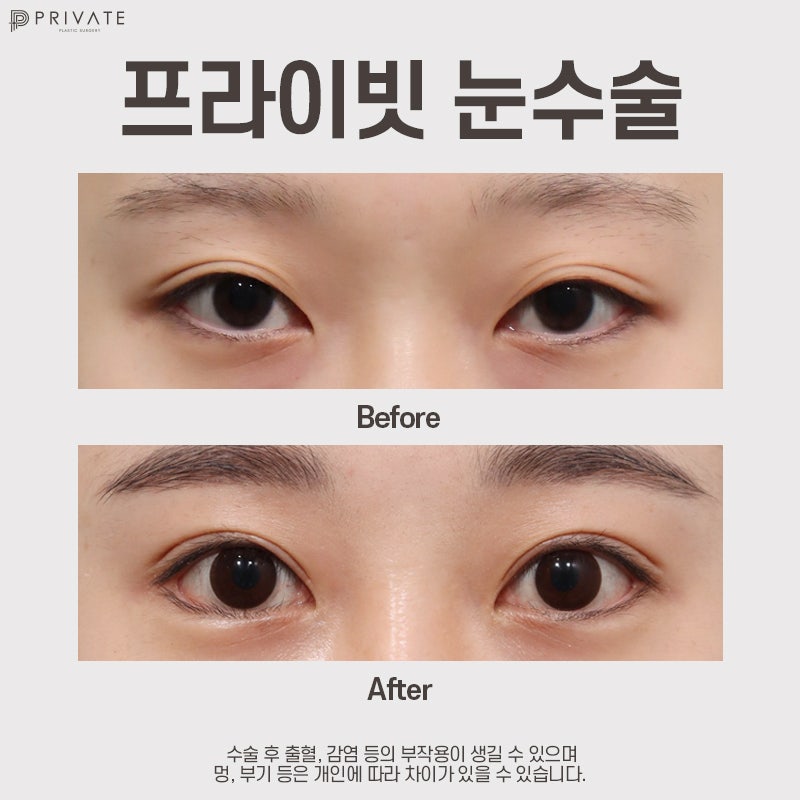 자연유착쌍꺼풀후기는 프라이빗성형외과 사진 8