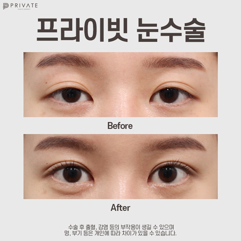자연유착쌍꺼풀후기는 프라이빗성형외과 사진 9