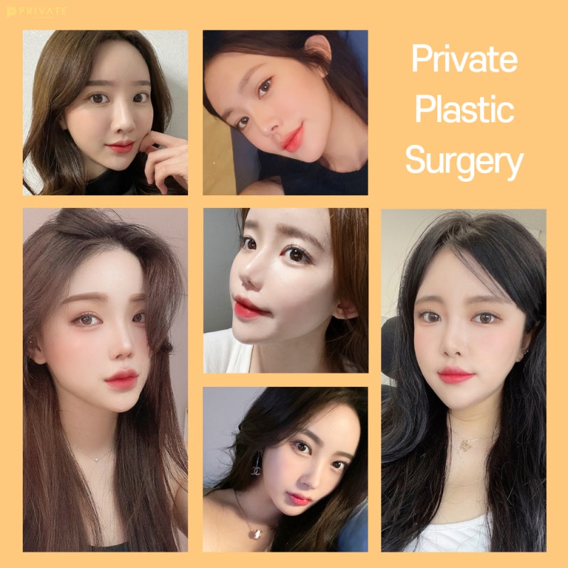 자연유착쌍꺼풀후기는 프라이빗성형외과 사진 7