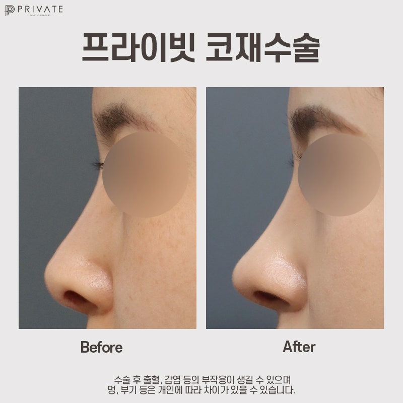 코재수술 성형후기가 좋은 프라이빗성형외과 사진 8