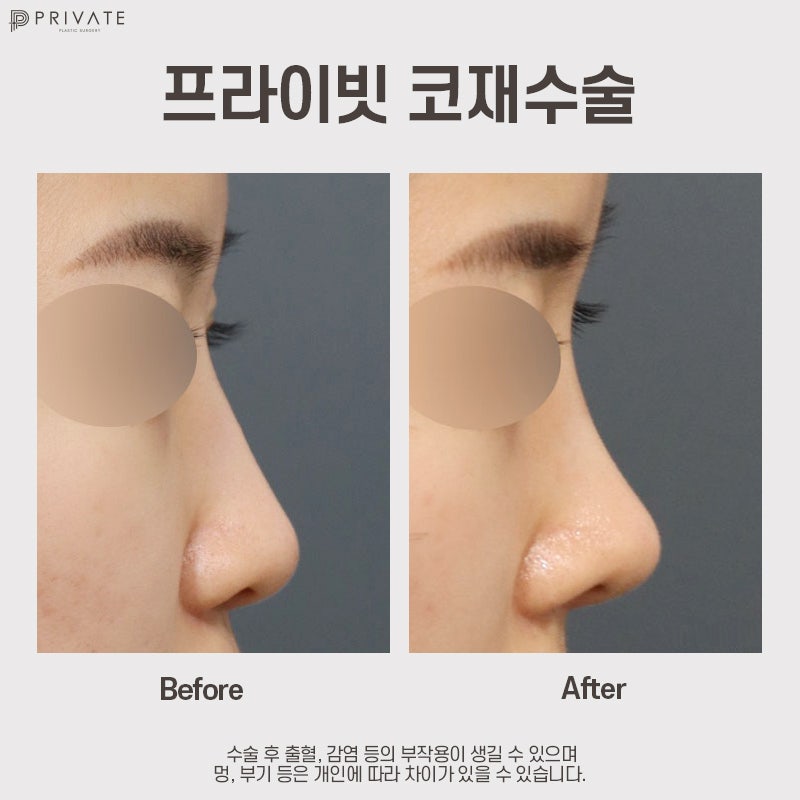 코재수술 성형후기가 좋은 프라이빗성형외과 사진 9