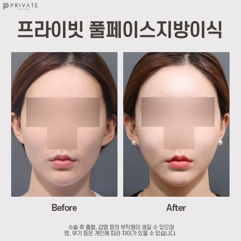 prp 지방이식 효과, 프라이빗성형외과에서 알아보자 사진 10