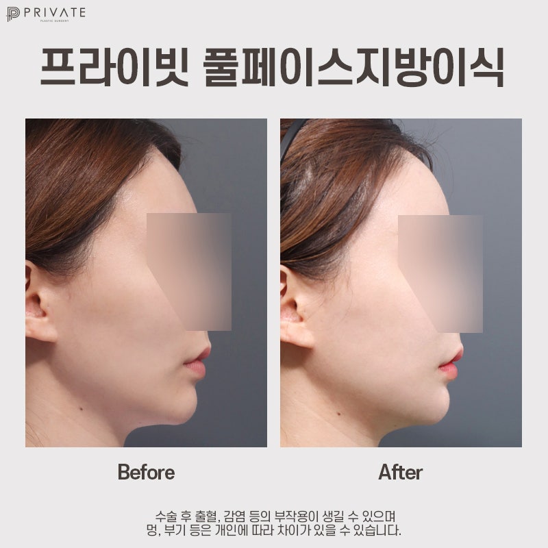 prp 지방이식 효과, 프라이빗성형외과에서 알아보자 사진 8