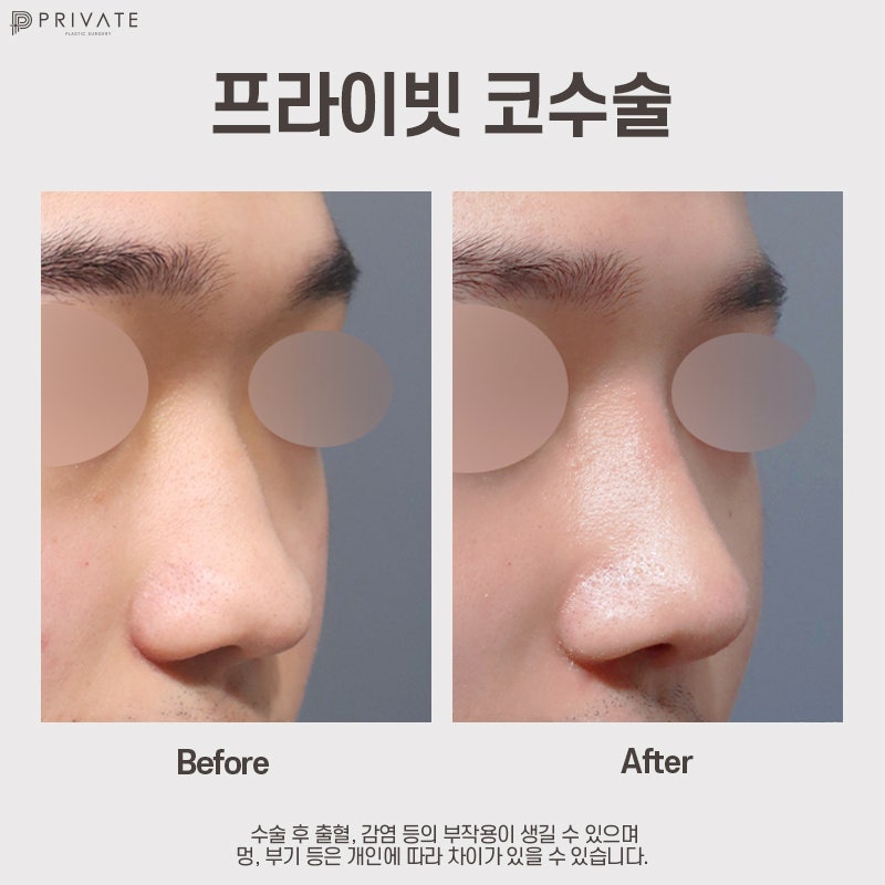 남자코성형잘하는곳은 프라이빗성형외과 사진 8