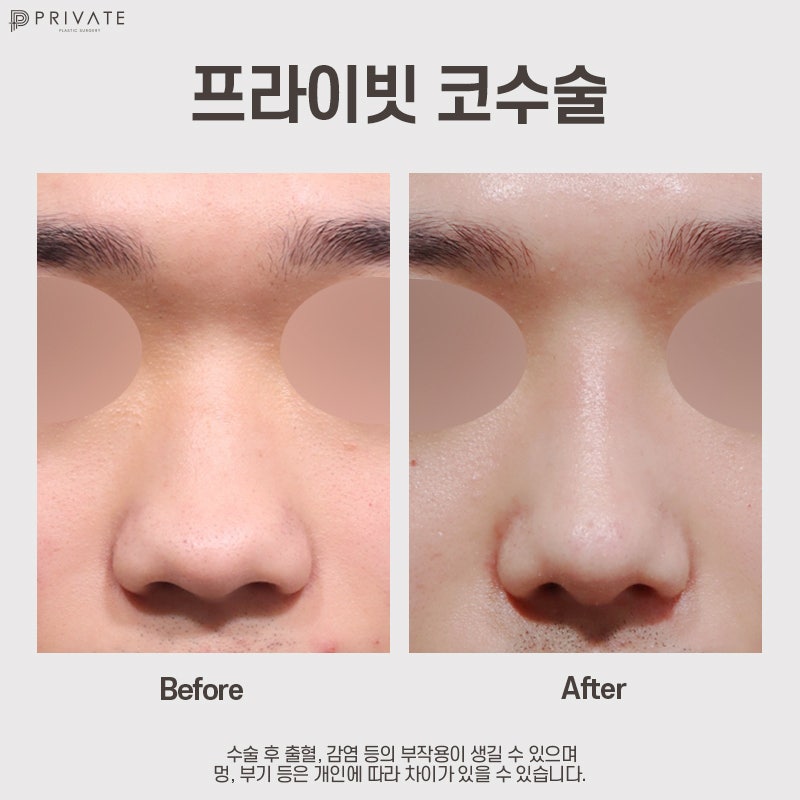 남자코성형잘하는곳은 프라이빗성형외과 사진 7
