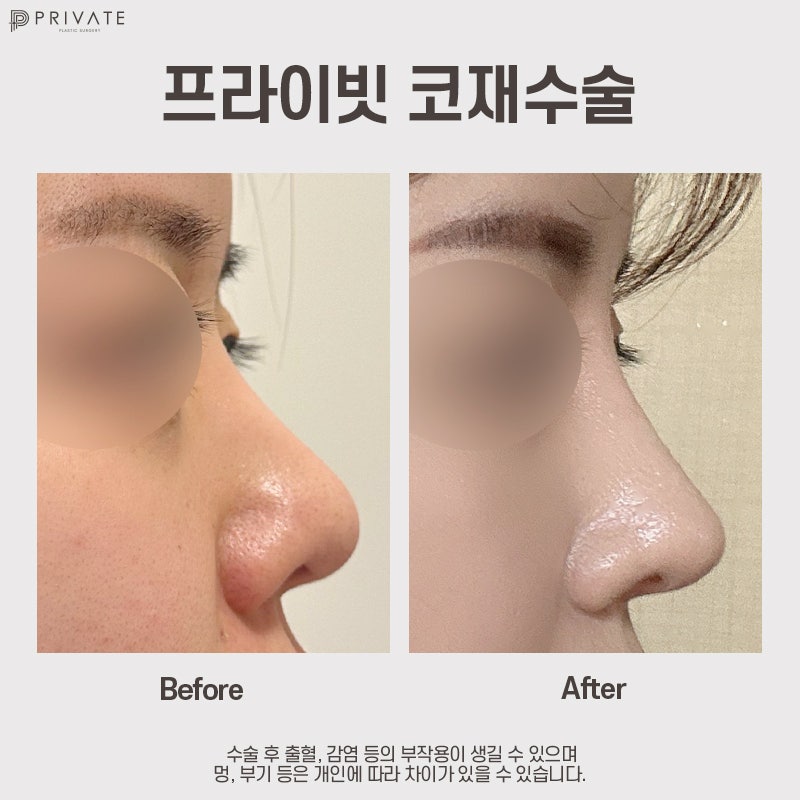 코재수술 잘하는곳은 프라이빗성형외과 사진 11