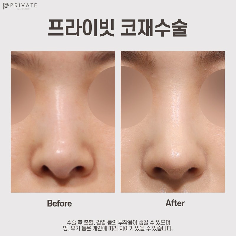 코재수술 잘하는곳은 프라이빗성형외과 사진 9
