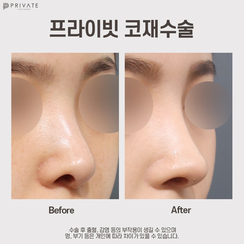 코재수술 잘하는곳은 프라이빗성형외과 사진 10