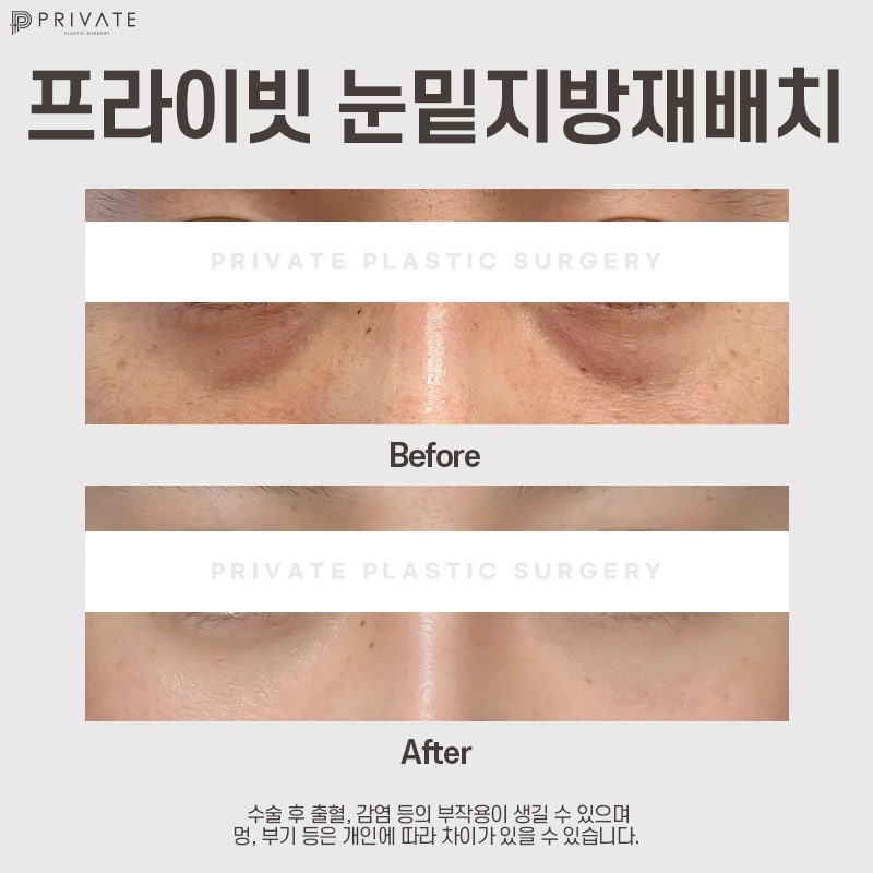 눈밑지 수술 후기 좋은 프라이빗성형외과 사진 9
