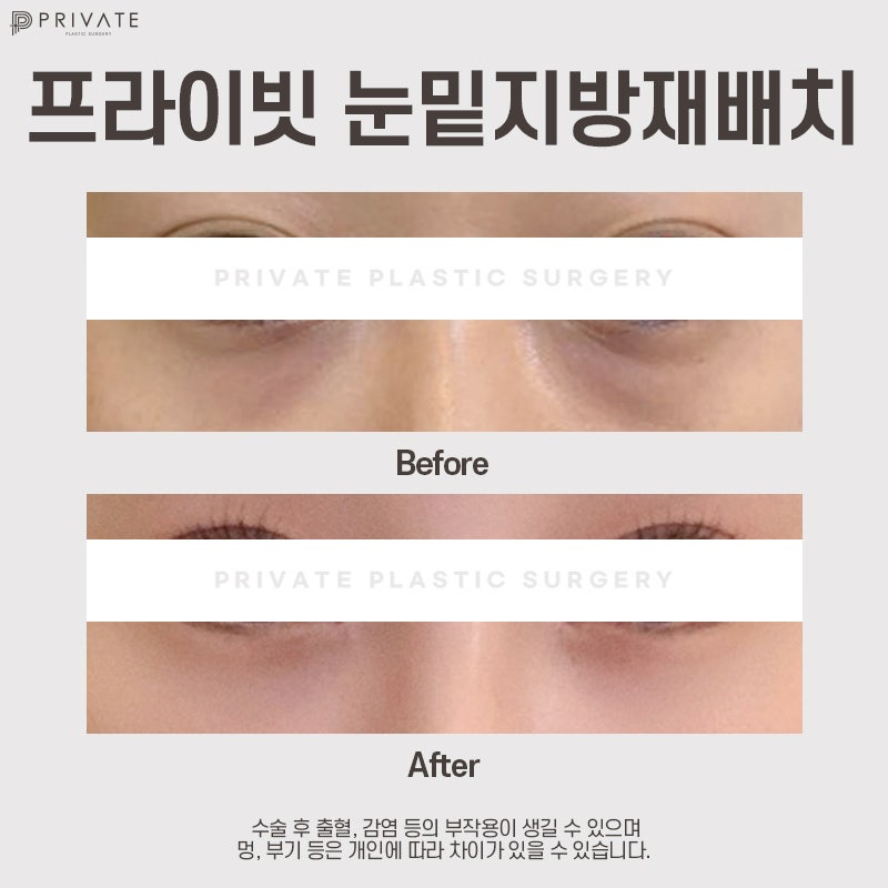 눈밑지 수술 후기 좋은 프라이빗성형외과 사진 8