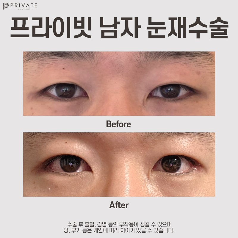 남자 쌍수 재수술 잘하는곳 프라이빗성형외과 사진 9