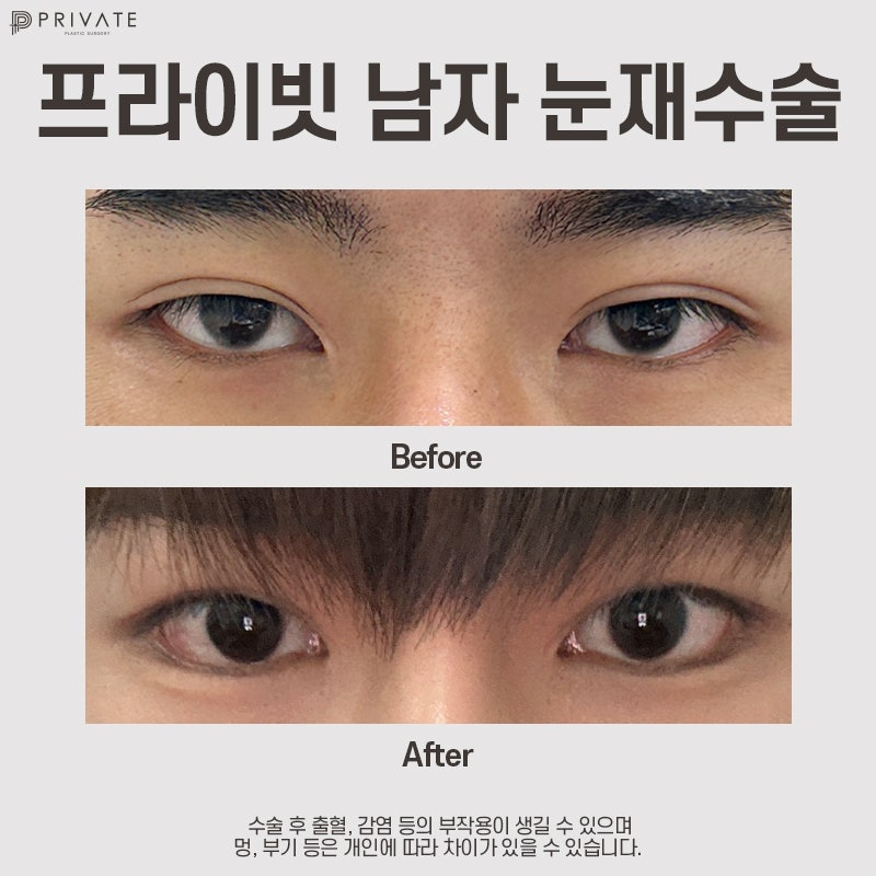 남자 쌍수 재수술 잘하는곳 프라이빗성형외과 사진 8