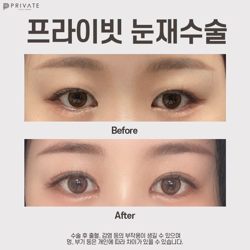 쌍수 재수술 잘하는곳은 프라이빗성형외과 사진 9