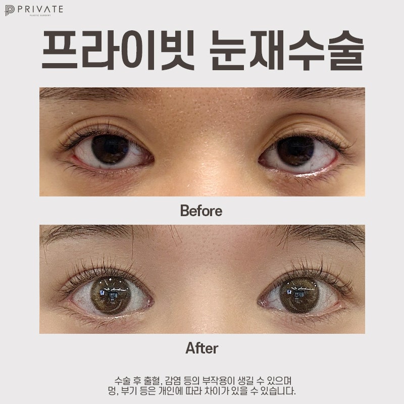 쌍수 재수술 잘하는곳은 프라이빗성형외과 사진 8