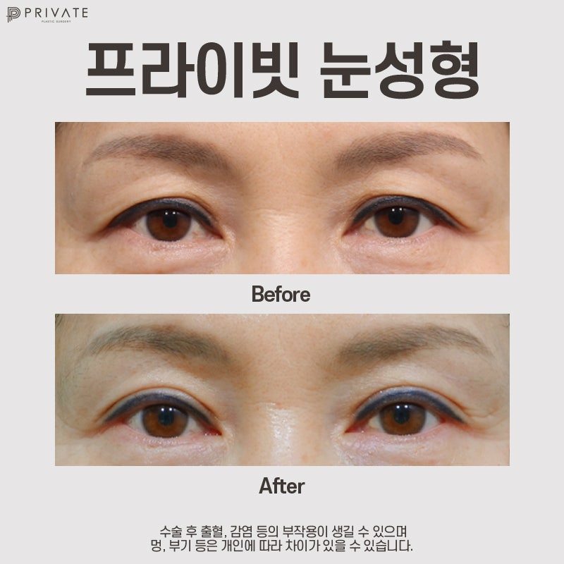 상안검수술후기 확인은 프라이빗성형외과 사진 7
