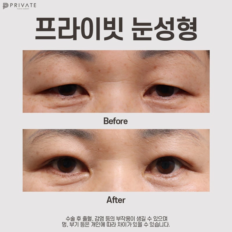 상안검수술후기 확인은 프라이빗성형외과 사진 8