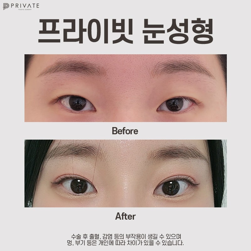 쌍수 잘하는 성형외과, 프라이빗성형외과 사진 8