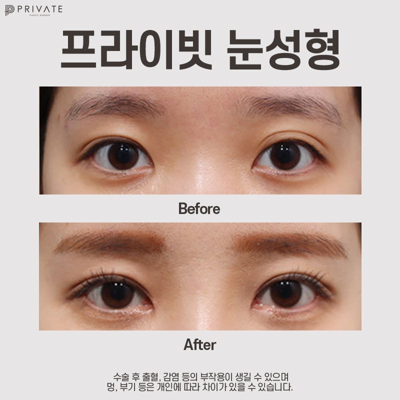 쌍수 잘하는 성형외과, 프라이빗성형외과 사진 9