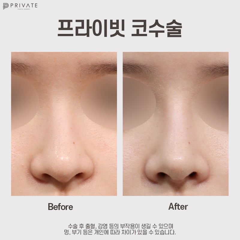 여자 코성형 후기가 좋은 프라이빗성형외과 사진 7