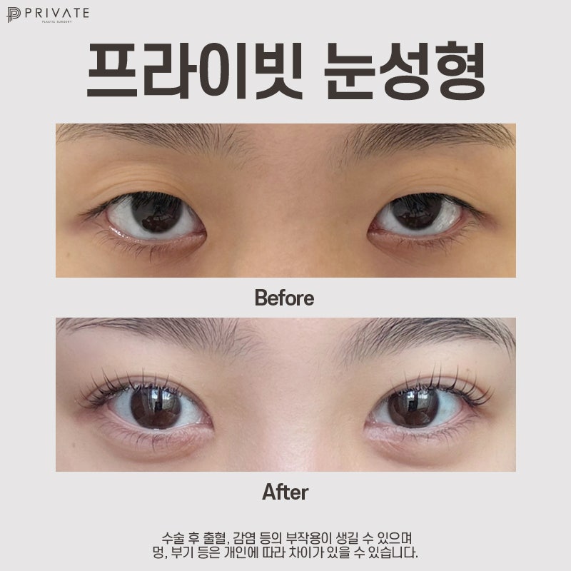 쌍수자연유착 신사 프라이빗성형외과에서 알아보자 사진 7
