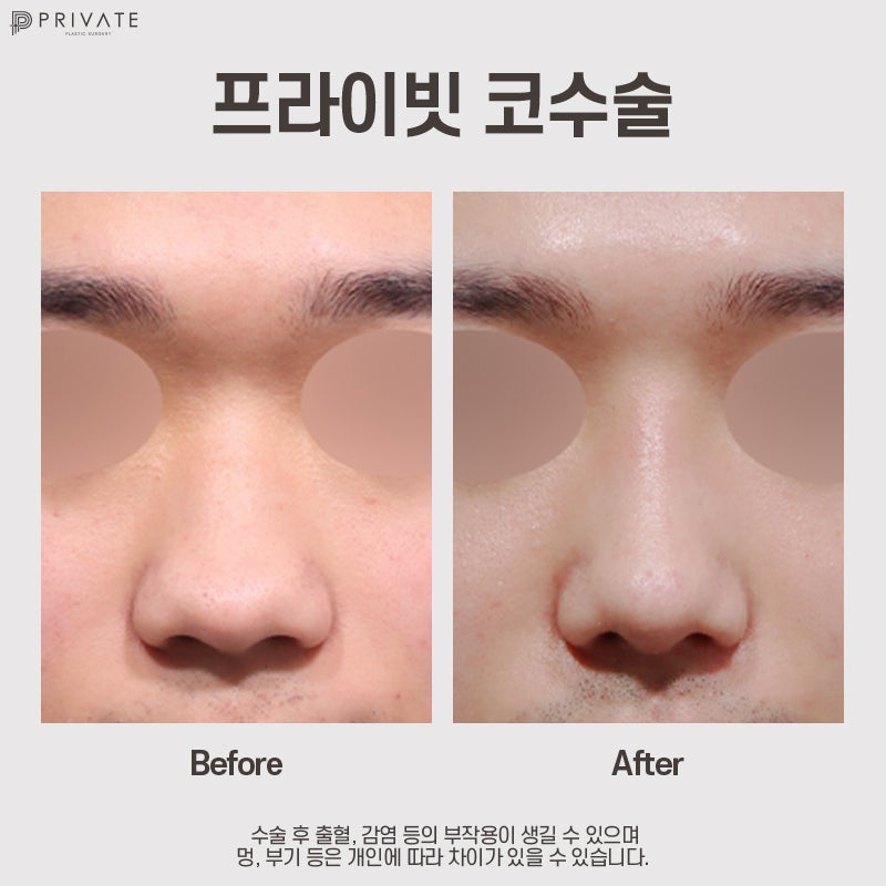 남자 코수술 병원은 신사 프라이빗성형외과 사진 8
