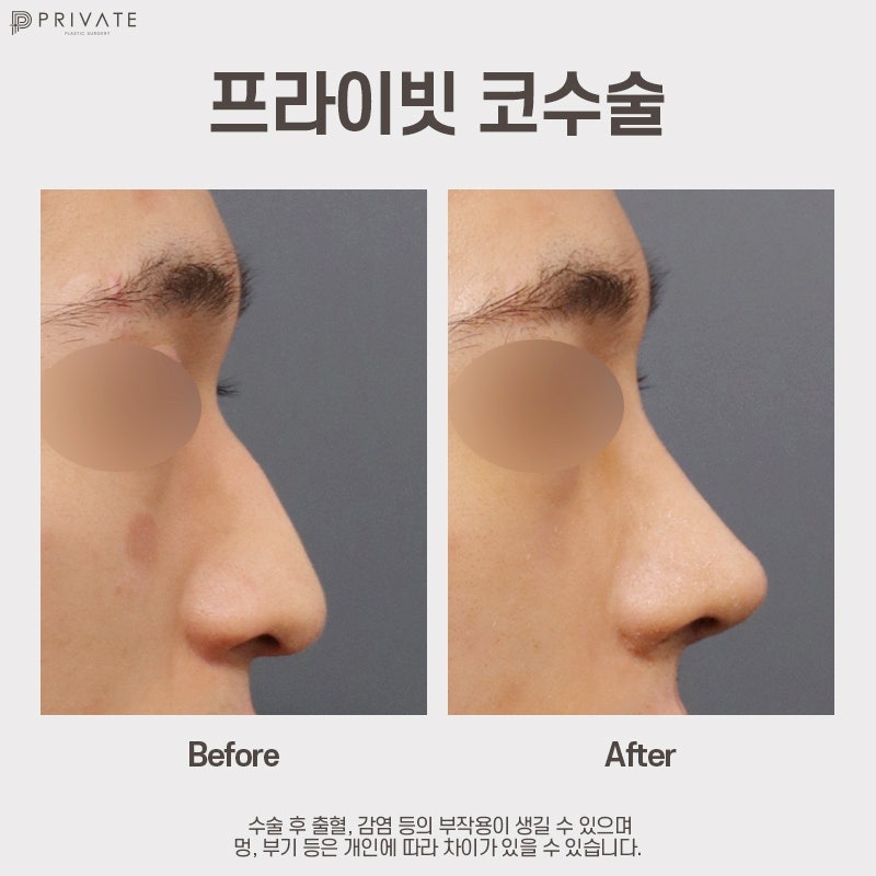 남자 코수술 병원은 신사 프라이빗성형외과 사진 7
