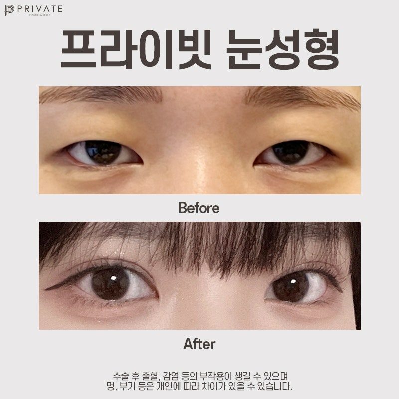 신사 프라이빗성형외과에서 쌍수 절개 후기 확인하기 사진 8