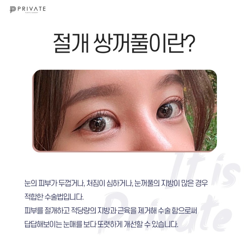 신사 프라이빗성형외과에서 쌍수 절개 후기 확인하기