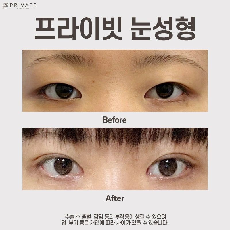 신사 프라이빗성형외과에서 쌍수 절개 후기 확인하기 사진 7