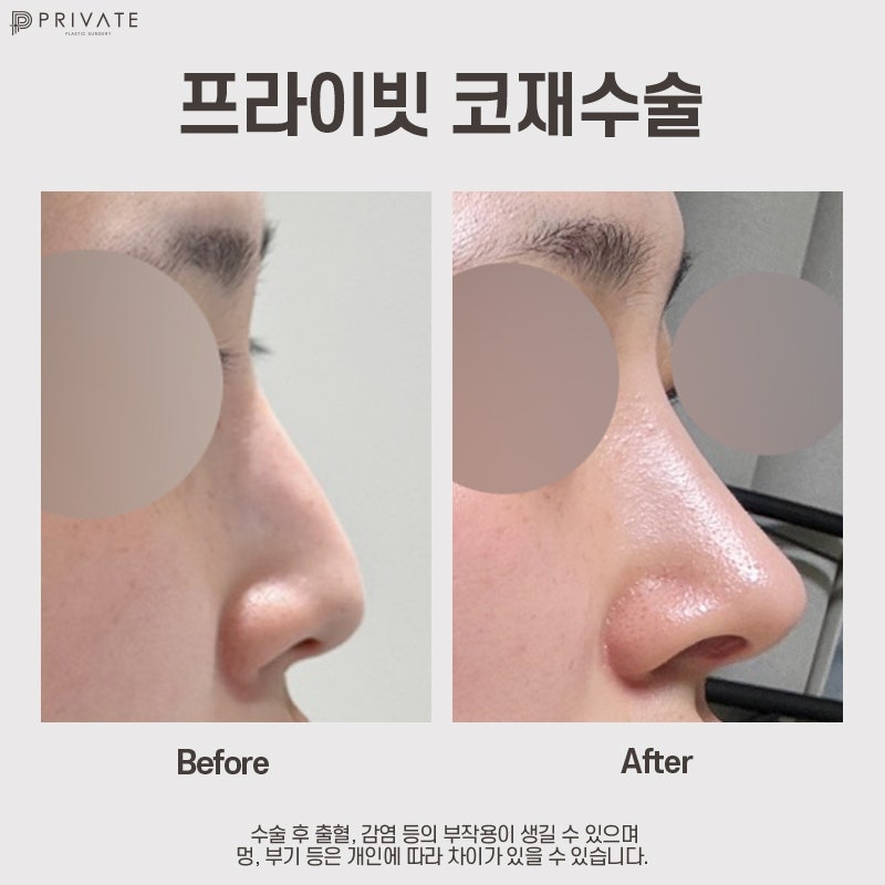 코재수술후기는 프라이빗성형외과 사진 7