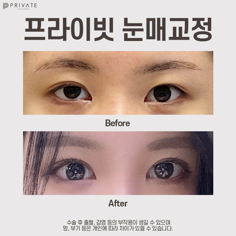 눈매교정수술전후 프라이빗성형외과에서 보기 사진 7
