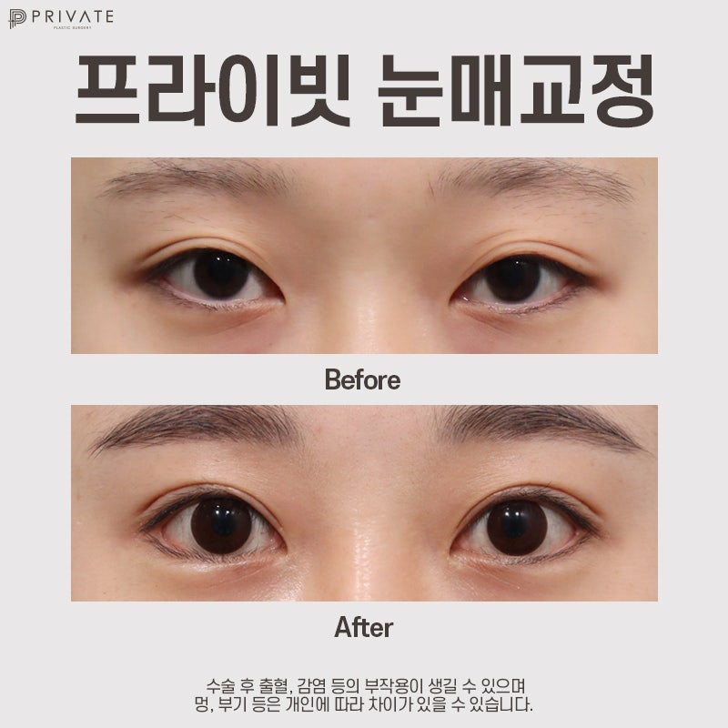 눈매교정수술전후 프라이빗성형외과에서 보기 사진 8