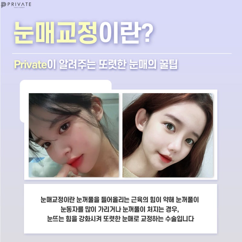 눈매교정수술전후 프라이빗성형외과에서 보기