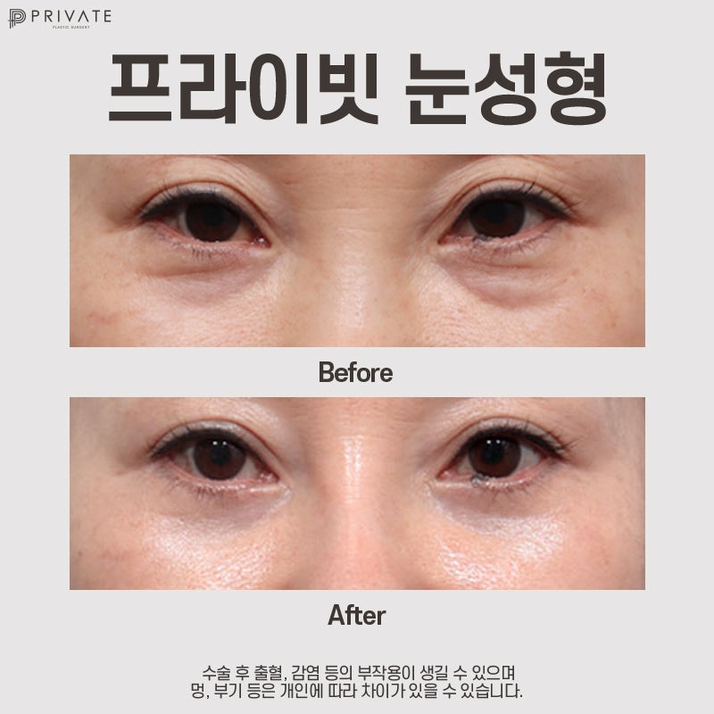 눈밑하안검수술은 신사 프라이빗성형외과 사진 8