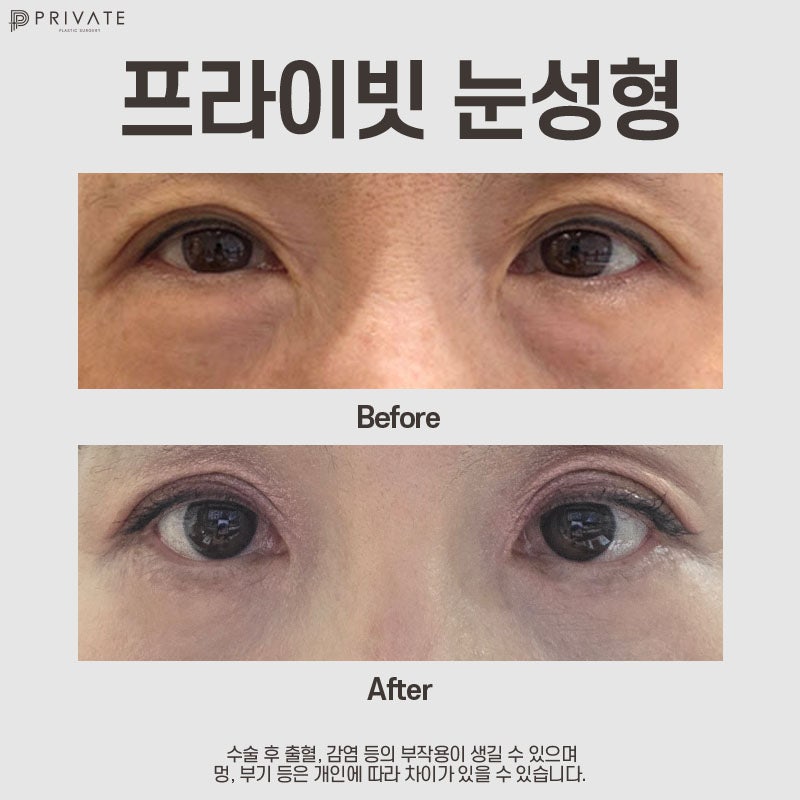 눈밑하안검수술은 신사 프라이빗성형외과 사진 7