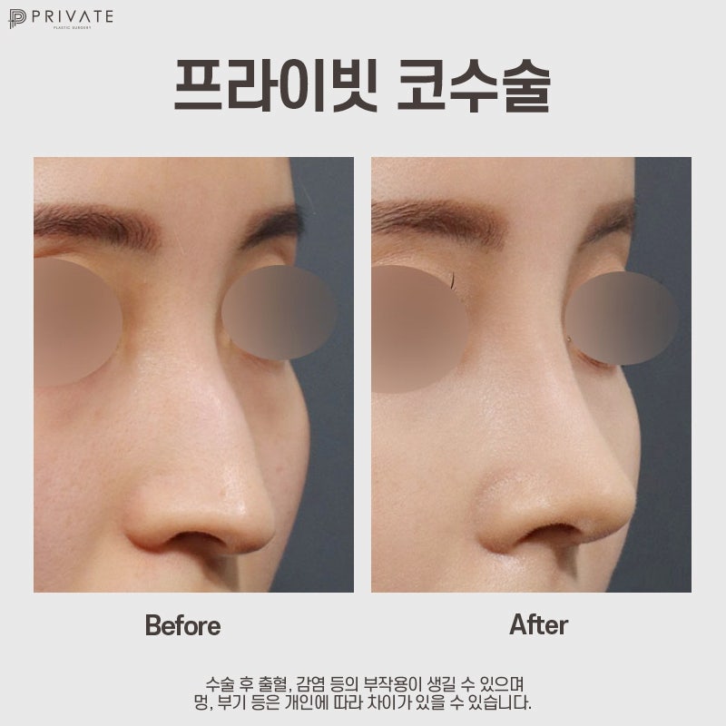 긴코 수술 후기 좋은 프라이빗성형외과 사진 8