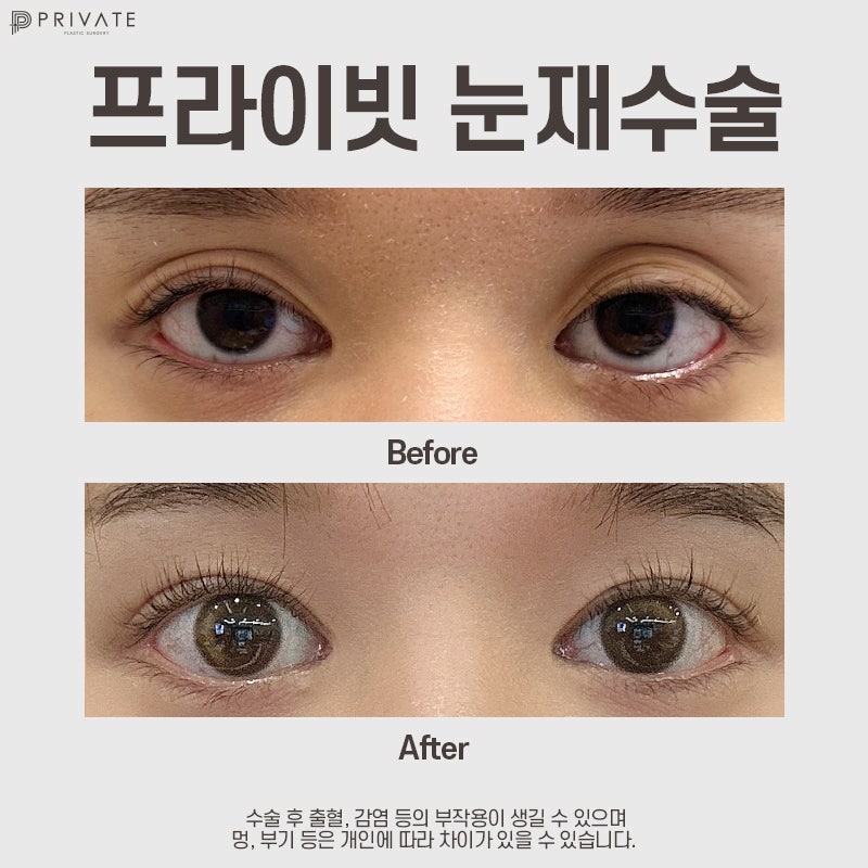 프라이빗성형외과 쌍수재수술후기 사진 7
